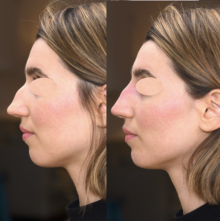 Embellir votre nez pour le rendre plus beau, plus joli, mieux proportionné par technique non invasive au fauteuil, sans hospitalisation ni bleus ni œdème avec résultat 12 à 18 mois en harmonie avec le reste du visage pour supprimer, faire disparaitre, a