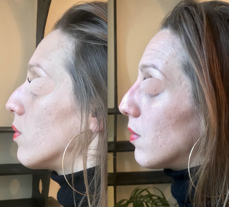 Embellir votre nez pour le rendre plus beau, plus joli, mieux proportionné par technique non invasive au fauteuil, sans hospitalisation ni bleus ni oedème avec résultat 12 à 18 mois en harmonie avec le reste du visage pour supprimer, faire disparaitre,