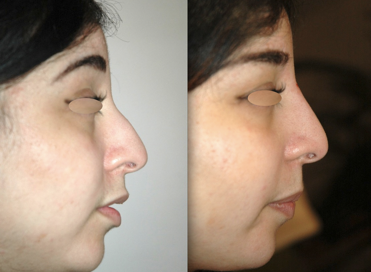 Embellir votre nez pour le rendre plus beau, plus joli, mieux proportionné par technique non invasive au fauteuil, sans hospitalisation ni bleus ni œdème avec résultat 12 à 18 mois en harmonie avec le reste du visage pour supprimer, faire disparaitre, a