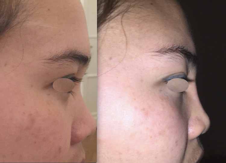 Embellir votre nez pour le rendre plus beau, plus joli, mieux proportionné par technique non invasive au fauteuil, sans hospitalisation ni bleus ni œdème avec résultat 12 à 18 mois en harmonie avec le reste du visage pour supprimer, faire disparaitre, a