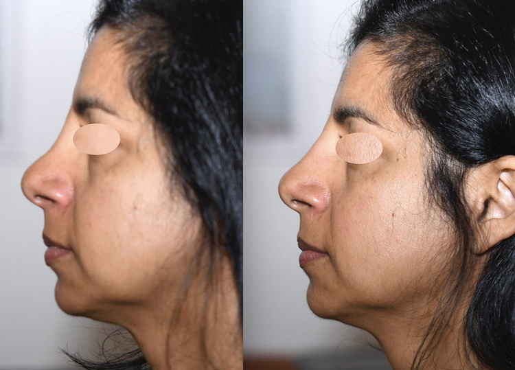 Embellir votre nez pour le rendre plus beau, plus joli, mieux proportionné par technique non invasive au fauteuil, sans hospitalisation ni bleus ni œdème avec résultat 12 à 18 mois en harmonie avec le reste du visage pour supprimer, faire disparaitre, a
