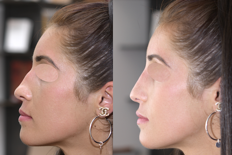 Embellir votre nez pour le rendre plus beau, plus joli, mieux proportionné par technique non invasive au fauteuil, sans hospitalisation ni bleus ni œdème avec résultat 12 à 18 mois en harmonie avec le reste du visage pour supprimer, faire disparaitre, a