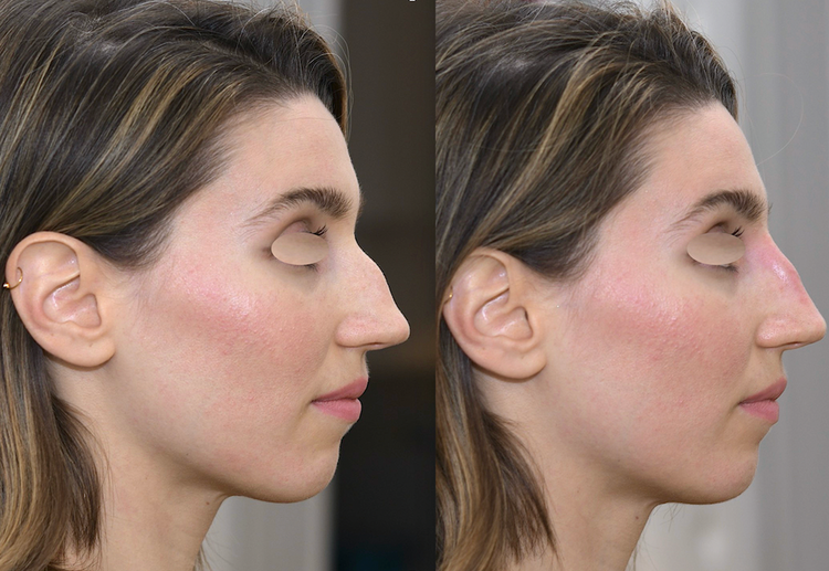 Embellir votre nez pour le rendre plus beau, plus joli, mieux proportionné par technique non invasive au fauteuil, sans hospitalisation ni bleus ni œdème avec résultat 12 à 18 mois en harmonie avec le reste du visage pour supprimer, faire disparaitre, a