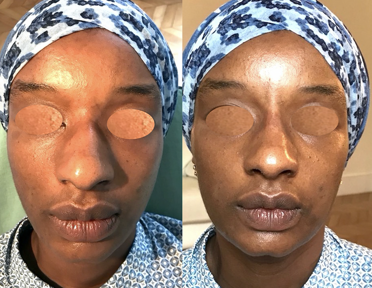 Embellir votre nez pour le rendre plus beau, plus joli, mieux proportionné par technique non invasive au fauteuil, sans hospitalisation ni bleus ni oedème avec résultat 12 à 18 mois en harmonie avec le reste du visage pour supprimer, faire disparaitre,