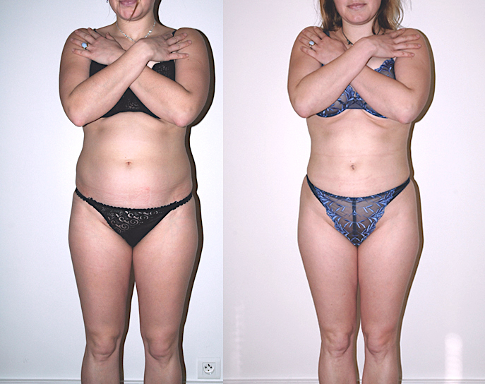 Beaucoup de question sur ce sujet de chirurgie et de médecine esthétique pour les hommes comme pour les femmes : C'est quoi la liposuccion, c’est quoi la lipoaspiration, est-ce méthode naturelle et peu invasive, douce. Pourquoi faire une liposuccion, Qu'e