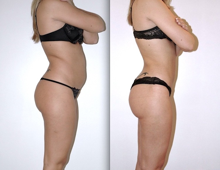 Beaucoup de question sur ce sujet de chirurgie et de médecine esthétique pour les hommes comme pour les femmes : C'est quoi la liposuccion, c’est quoi la lipoaspiration, est-ce méthode naturelle et peu invasive, douce. Pourquoi faire une liposuccion, Qu'e