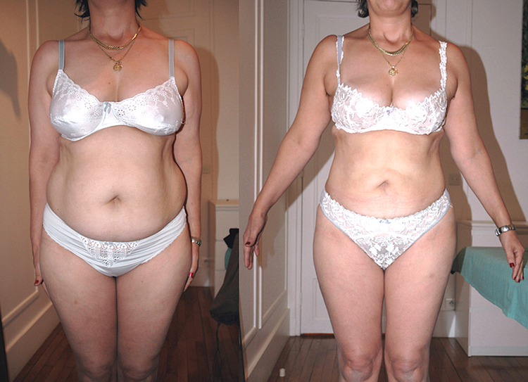 Beaucoup de question sur ce sujet de chirurgie et de médecine esthétique pour les hommes comme pour les femmes : C'est quoi la liposuccion, c’est quoi la lipoaspiration, est-ce méthode naturelle et peu invasive, douce. Pourquoi faire une liposuccion, Qu'e