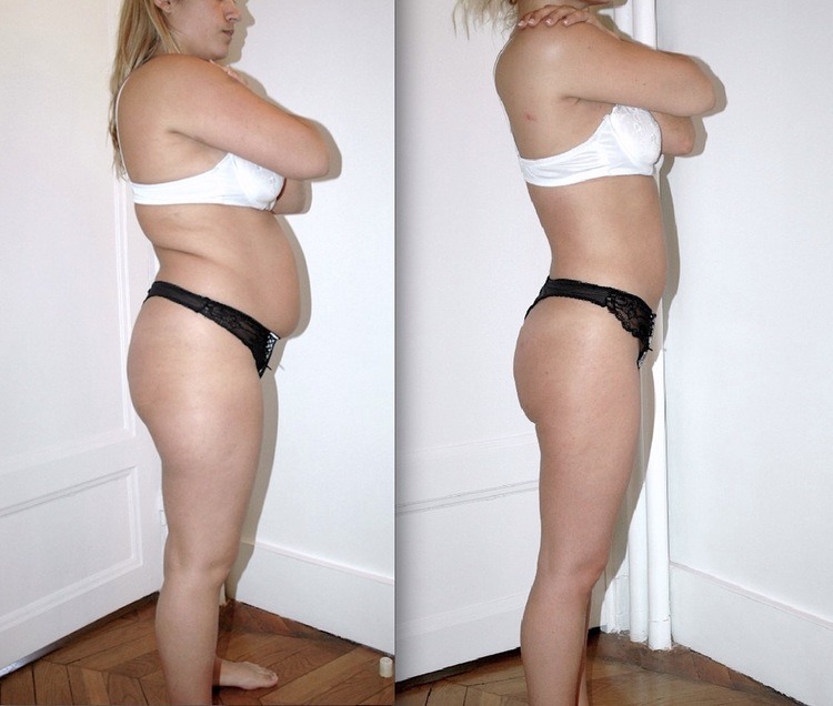 Beaucoup de question sur ce sujet de chirurgie et de médecine esthétique pour les hommes comme pour les femmes : C'est quoi la liposuccion, c’est quoi la lipoaspiration, est-ce méthode naturelle et peu invasive, douce. Pourquoi faire une liposuccion, Qu'e