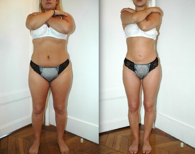 Beaucoup de question sur ce sujet de chirurgie et de médecine esthétique pour les hommes comme pour les femmes : C'est quoi la liposuccion, c’est quoi la lipoaspiration, est-ce méthode naturelle et peu invasive, douce. Pourquoi faire une liposuccion, Qu'e