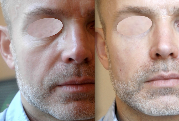 Les principales indications sont le remplissage des tempes creuses, les fronts marqués, les contours des yeux fatigués pour une meilleure plénitude des paupières, une meilleure définition du contour des yeux, la lutte contre les cernes qui sont effacés, l