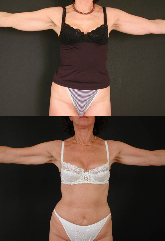 Liposuccion sans chirurgie, voire Liposuccion sans opération par le froid ou les ultrasons, voire les infrarouges ou les LED, avec ou sans lipofilling des seins ou des fesses associés par injection de graisse,