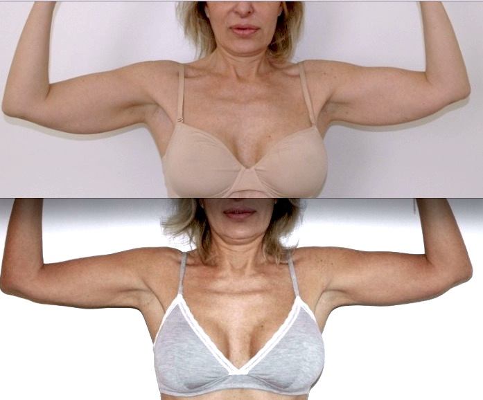 faut-il panty, gaine, vêtement de compression, pendant combien de temps, indispensable ou non.