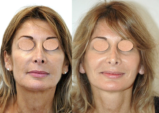 Rajeunir, embellir ovale visage et cou, ovale plus net, bien dessinée, cou net et lisse, méthode non invasive, chirurgie douce, expertise