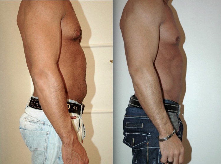 Beaucoup de question sur ce sujet de chirurgie et de médecine esthétique pour les hommes comme pour les femmes : C'est quoi la liposuccion, c’est quoi la lipoaspiration, est-ce méthode naturelle et peu invasive, douce. Pourquoi faire une liposuccion, Qu'e