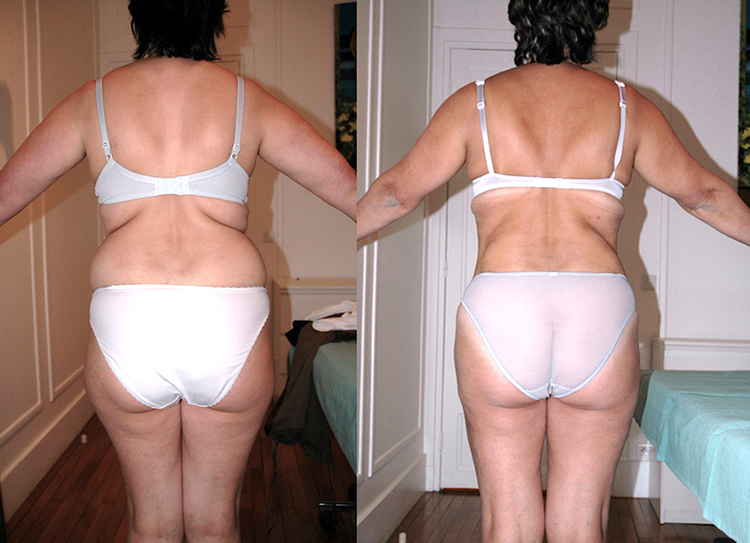 Beaucoup de question sur ce sujet de chirurgie et de médecine esthétique pour les hommes comme pour les femmes : C'est quoi la liposuccion, c’est quoi la lipoaspiration, est-ce méthode naturelle et peu invasive, douce. Pourquoi faire une liposuccion, Qu'e