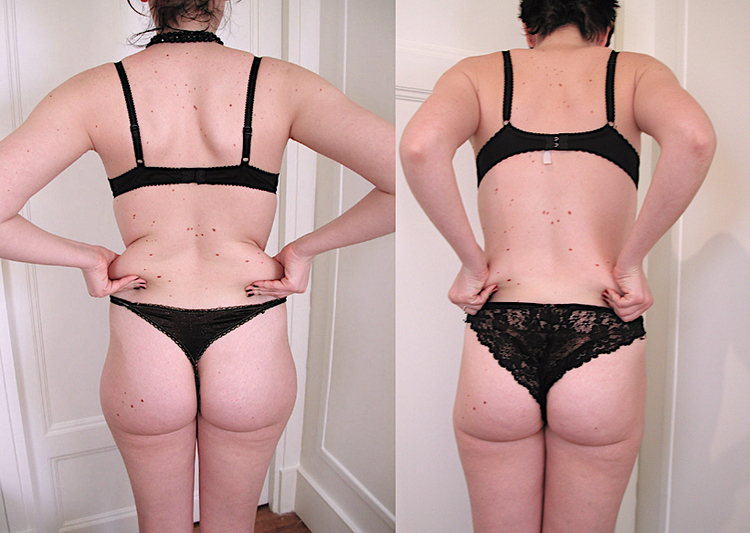Beaucoup de question sur ce sujet de chirurgie et de médecine esthétique pour les hommes comme pour les femmes : C'est quoi la liposuccion, c’est quoi la lipoaspiration, est-ce méthode naturelle et peu invasive, douce. Pourquoi faire une liposuccion, Qu'e