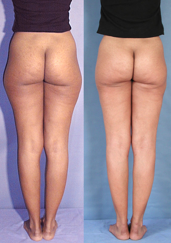 Beaucoup de question sur ce sujet de chirurgie et de médecine esthétique pour les hommes comme pour les femmes : C'est quoi la liposuccion, c’est quoi la lipoaspiration, est-ce méthode naturelle et peu invasive, douce. Pourquoi faire une liposuccion, Qu'e