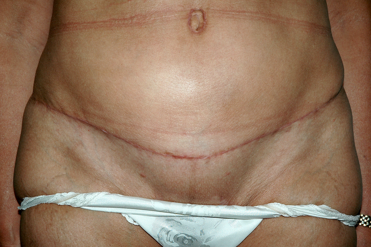 Chirurgie esthétique et réparatrice pour embellissement et rajeunissement abdomen ventre lombes poignées d’amour bourrelets du dos. Indications bien plus efficaces Infiniment plus efficiente sur la peau relâchée du ventre et la graisse que les soins aminc