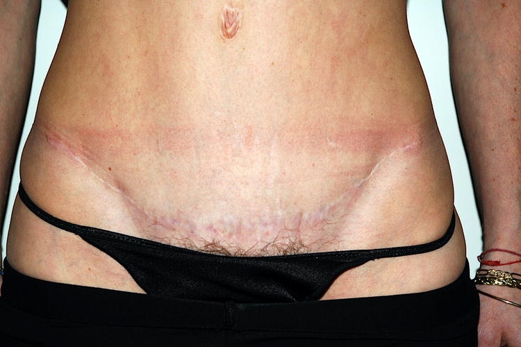 Chirurgie esthétique et réparatrice pour embellissement et rajeunissement abdomen ventre lombes poignées d’amour bourrelets du dos. Indications bien plus efficaces Infiniment plus efficiente sur la peau relâchée du ventre et la graisse que les soins aminc