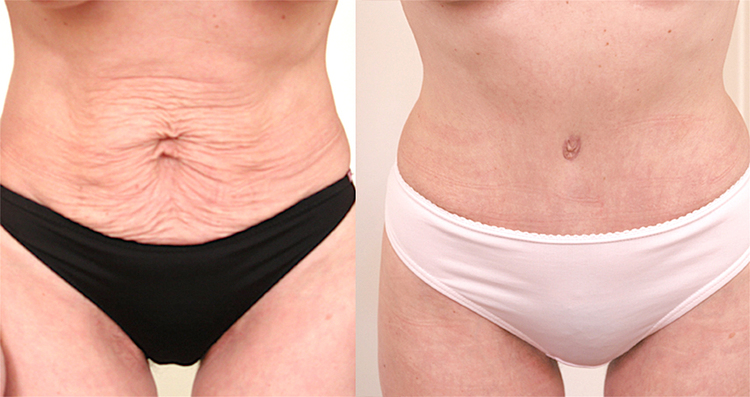 Chirurgie esthétique et réparatrice pour embellissement et rajeunissement abdomen ventre lombes poignées d’amour bourrelets du dos. Indications bien plus efficaces Infiniment plus efficiente sur la peau relâchée du ventre et la graisse que les soins aminc