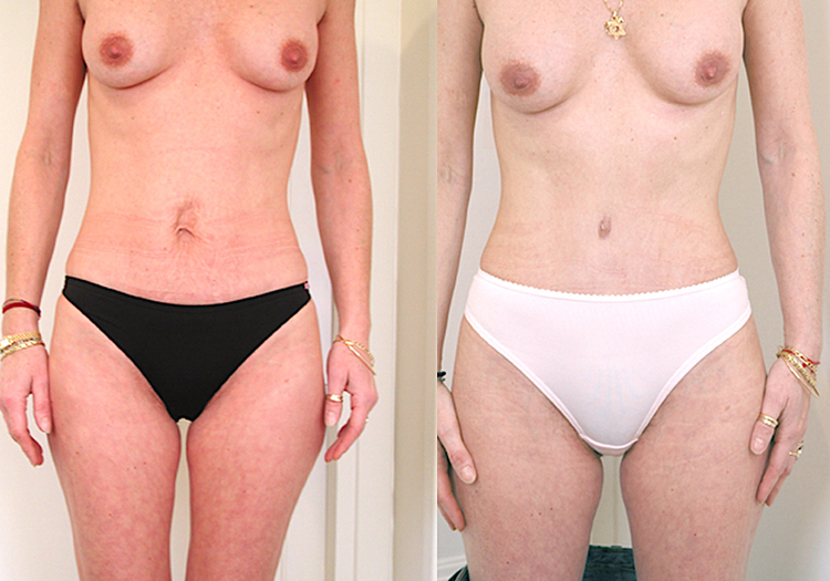 Chirurgie esthétique et réparatrice pour embellissement et rajeunissement abdomen ventre lombes poignées d’amour bourrelets du dos. Indications bien plus efficaces Infiniment plus efficiente sur la peau relâchée du ventre et la graisse que les soins aminc