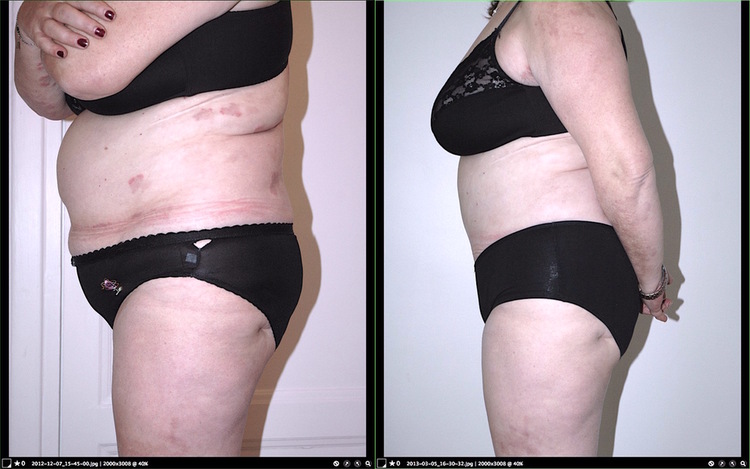 Chirurgie esthétique et réparatrice pour embellissement et rajeunissement abdomen ventre lombes poignées d’amour bourrelets du dos. Indications bien plus efficaces Infiniment plus efficiente sur la peau relâchée du ventre et la graisse que les soins aminc