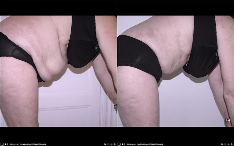Chirurgie esthétique et réparatrice pour embellissement et rajeunissement abdomen ventre lombes poignées d’amour bourrelets du dos. Indications bien plus efficaces Infiniment plus efficiente sur la peau relâchée du ventre et la graisse que les soins aminc