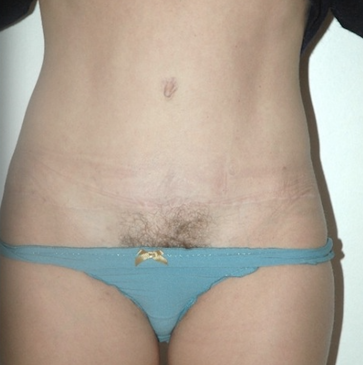 Chirurgie esthétique et réparatrice pour embellissement et rajeunissement abdomen ventre lombes poignées d’amour bourrelets du dos. Indications bien plus efficaces Infiniment plus efficiente sur la peau relâchée du ventre et la graisse que les soins aminc