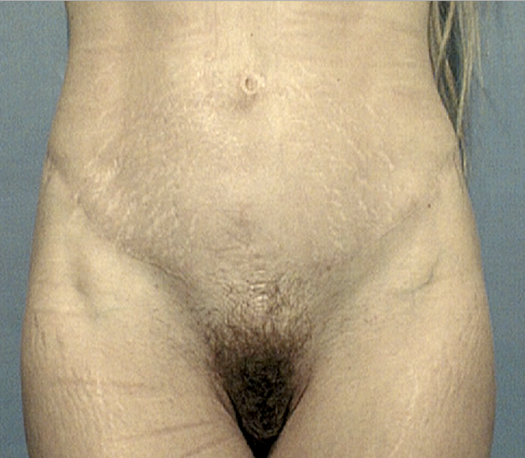 Chirurgie esthétique et réparatrice pour embellissement et rajeunissement abdomen ventre lombes poignées d’amour bourrelets du dos. Indications bien plus efficaces Infiniment plus efficiente sur la peau relâchée du ventre et la graisse que les soins aminc