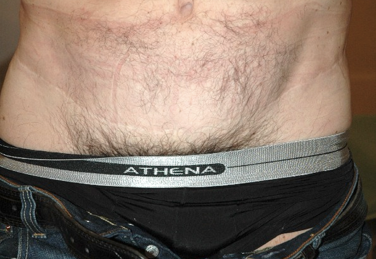 Chirurgie esthétique et réparatrice pour embellissement et rajeunissement abdomen ventre lombes poignées d’amour bourrelets du dos. Indications bien plus efficaces Infiniment plus efficiente sur la peau relâchée du ventre et la graisse que les soins aminc