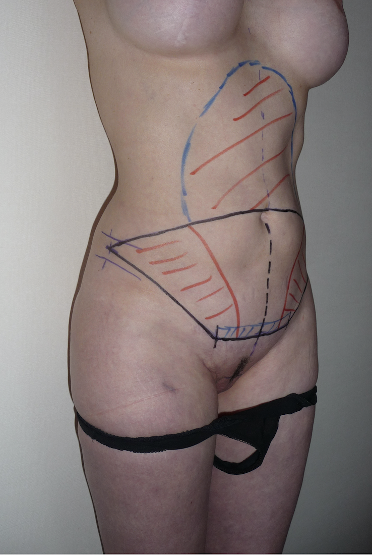 Chirurgie esthétique et réparatrice pour embellissement et rajeunissement abdomen ventre lombes poignées d’amour bourrelets du dos. Indications bien plus efficaces Infiniment plus efficiente sur la peau relâchée du ventre et la graisse que les soins aminc