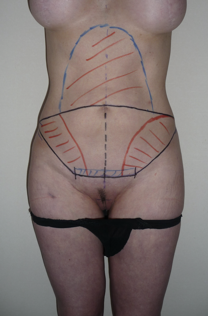 Chirurgie esthétique et réparatrice pour embellissement et rajeunissement abdomen ventre lombes poignées d’amour bourrelets du dos. Indications bien plus efficaces Infiniment plus efficiente sur la peau relâchée du ventre et la graisse que les soins aminc