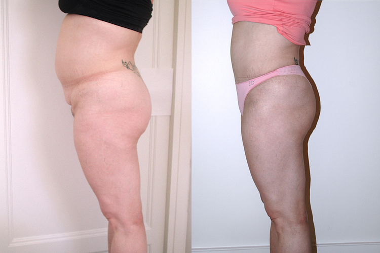 Chirurgie esthétique et réparatrice pour embellissement et rajeunissement abdomen ventre lombes poignées d’amour bourrelets du dos. Indications bien plus efficaces Infiniment plus efficiente sur la peau relâchée du ventre et la graisse que les soins aminc