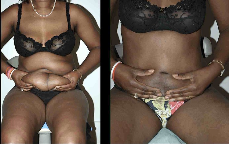 Chirurgie esthétique et réparatrice pour embellissement et rajeunissement abdomen ventre lombes poignées d’amour bourrelets du dos. Indications bien plus efficaces Infiniment plus efficiente sur la peau relâchée du ventre et la graisse que les soins aminc