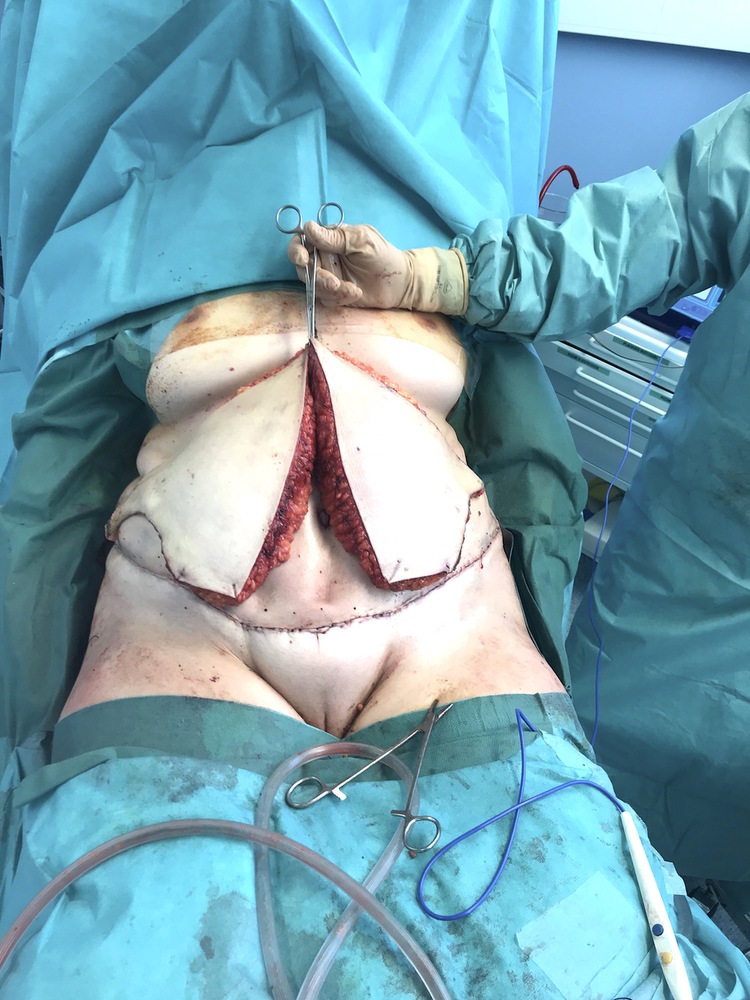 Chirurgie esthétique et réparatrice pour embellissement et rajeunissement abdomen ventre lombes poignées d’amour bourrelets du dos. Indications bien plus efficaces Infiniment plus efficiente sur la peau relâchée du ventre et la graisse que les soins aminc