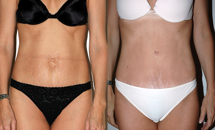 Chirurgie esthétique et réparatrice pour embellissement et rajeunissement abdomen ventre lombes poignées d’amour bourrelets du dos. Indications bien plus efficaces Infiniment plus efficiente sur la peau relâchée du ventre et la graisse que les soins aminc