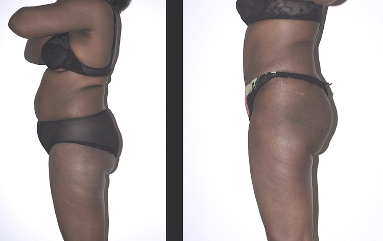 Chirurgie esthétique et réparatrice pour embellissement et rajeunissement abdomen ventre lombes poignées d’amour bourrelets du dos. Indications bien plus efficaces Infiniment plus efficiente sur la peau relâchée du ventre et la graisse que les soins aminc