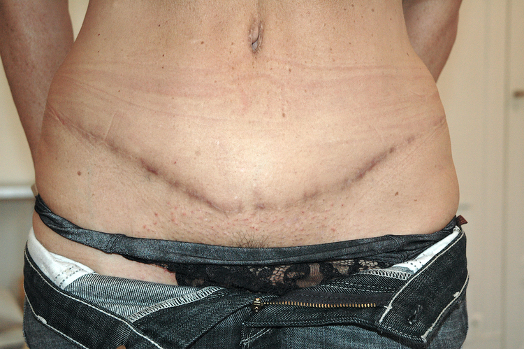 Chirurgie esthétique et réparatrice pour embellissement et rajeunissement abdomen ventre lombes poignées d’amour bourrelets du dos. Indications bien plus efficaces Infiniment plus efficiente sur la peau relâchée du ventre et la graisse que les soins aminc