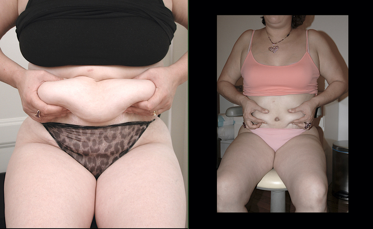 Chirurgie esthétique et réparatrice pour embellissement et rajeunissement abdomen ventre lombes poignées d’amour bourrelets du dos. Indications bien plus efficaces Infiniment plus efficiente sur la peau relâchée du ventre et la graisse que les soins aminc