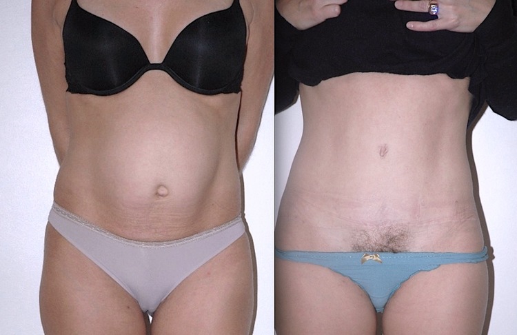 Chirurgie esthétique et réparatrice pour embellissement et rajeunissement abdomen ventre lombes poignées d’amour bourrelets du dos. Indications bien plus efficaces Infiniment plus efficiente sur la peau relâchée du ventre et la graisse que les soins aminc