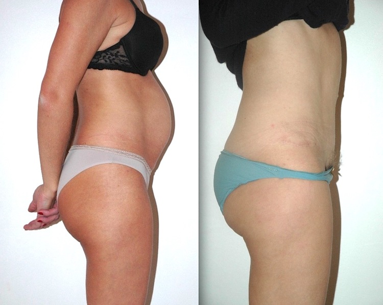 Chirurgie esthétique et réparatrice pour embellissement et rajeunissement abdomen ventre lombes poignées d’amour bourrelets du dos. Indications bien plus efficaces Infiniment plus efficiente sur la peau relâchée du ventre et la graisse que les soins aminc