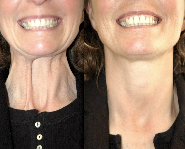 La Toxine botulique (Botox, Azzalure, Bocouture, Vistabel Allergan) est le produit phare de la médecine esthétique mais aussi en chirurgie esthétique. Les Injections sont destinées à la lutte contre les rides et les traces du vieillissement comme tendre l
