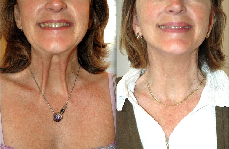 La Toxine botulique (Botox, Azzalure, Bocouture, Vistabel Allergan) est le produit phare de la médecine esthétique mais aussi en chirurgie esthétique. Les Injections sont destinées à la lutte contre les rides et les traces du vieillissement comme tendre l