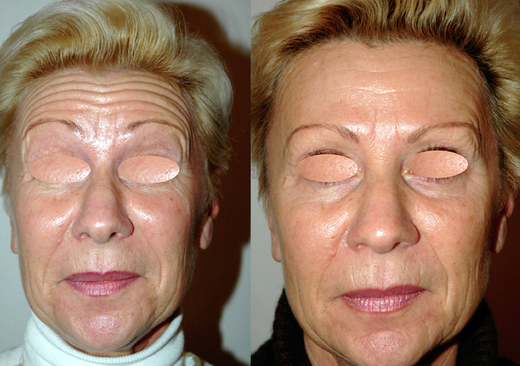 La Toxine botulique (Botox, Azzalure, Bocouture, Vistabel Allergan) est le produit phare de la médecine esthétique mais aussi en chirurgie esthétique. Les Injections sont destinées à la lutte contre les rides et les traces du vieillissement comme tendre l