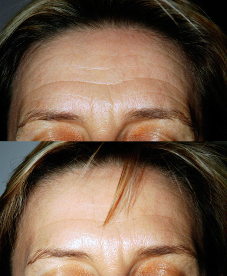 La Toxine botulique (Botox, Azzalure, Bocouture, Vistabel Allergan) est le produit phare de la médecine esthétique mais aussi en chirurgie esthétique. Les Injections sont destinées à la lutte contre les rides et les traces du vieillissement comme tendre l