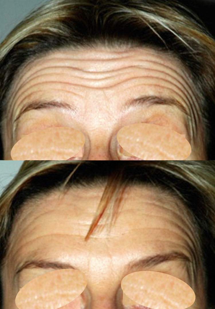 La Toxine botulique (Botox, Azzalure, Bocouture, Vistabel Allergan) est le produit phare de la médecine esthétique mais aussi en chirurgie esthétique. Les Injections sont destinées à la lutte contre les rides et les traces du vieillissement comme tendre l