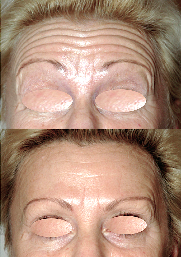 La Toxine botulique (Botox, Azzalure, Bocouture, Vistabel Allergan) est le produit phare de la médecine esthétique mais aussi en chirurgie esthétique. Les Injections sont destinées à la lutte contre les rides et les traces du vieillissement comme tendre l