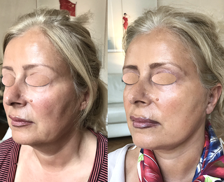 Technique de référence pour sculpter, éliminer, faire disparaitre, traiter un visage et un menton empâté qui vous dérange par la chirurgie esthétique non invasive douce, elle consiste à aspirer la graisse sous anesthésie locale ou générale en ambulatoire,